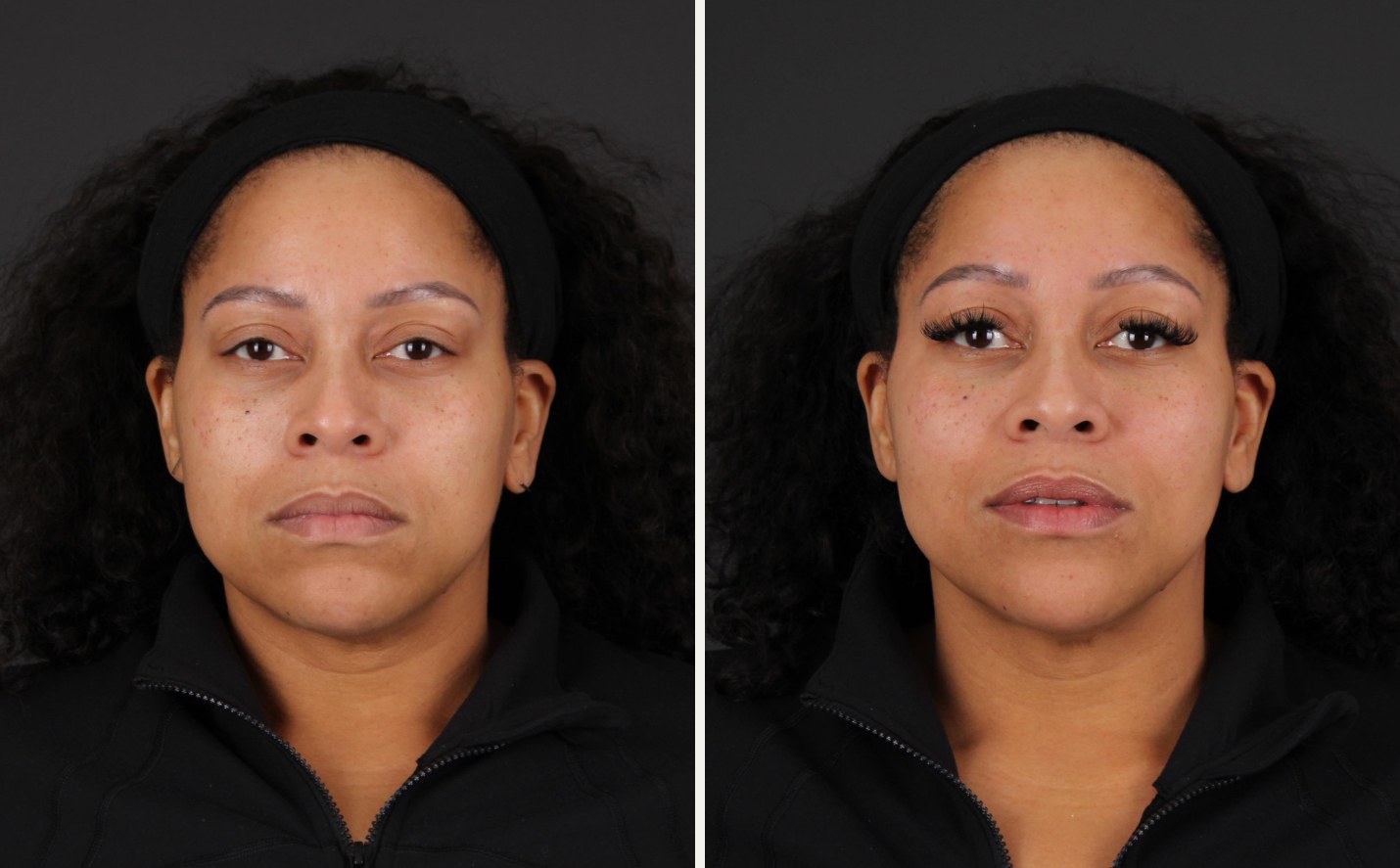 Front view of a female patient at rest before and after neuromodulator treatment, showing a smoother forehead, more open brows and a softer lower face