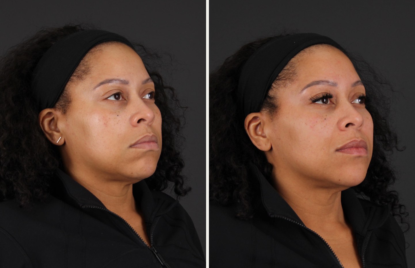 Three-quarter view of the same patient before and after neuromodulator treatment, showing a smoother forehead and a cleaner jawline