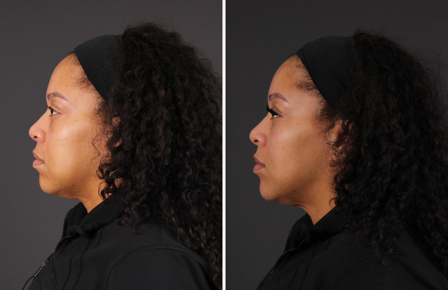 Side profile of the same patient before and after neuromodulator treatment, showing a smoother forehead and a more defined jaw and neck angle