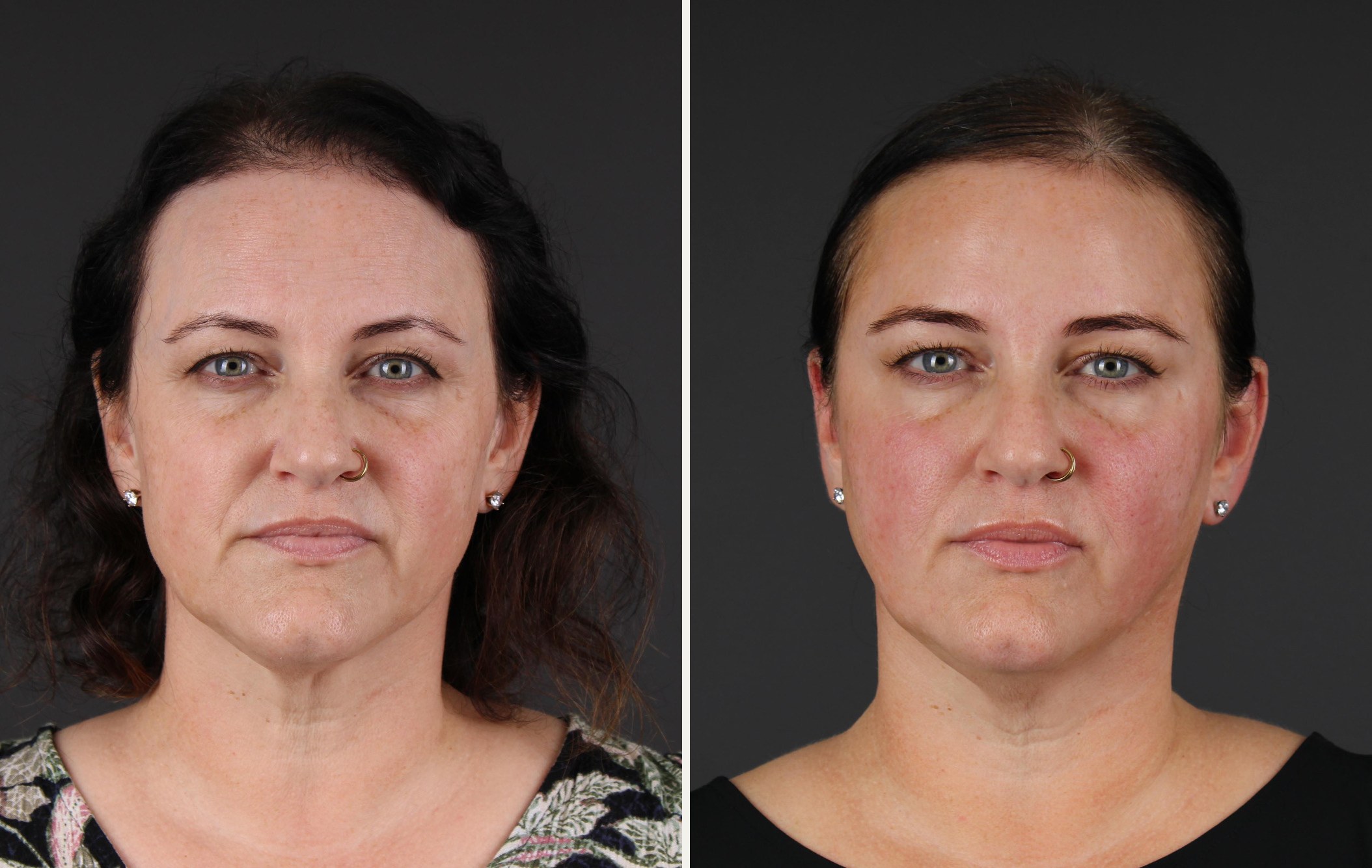 Front view of the same female patient at rest before and after neuromodulator treatment and a skincare routine, showing a smoother forehead and a more rested expression