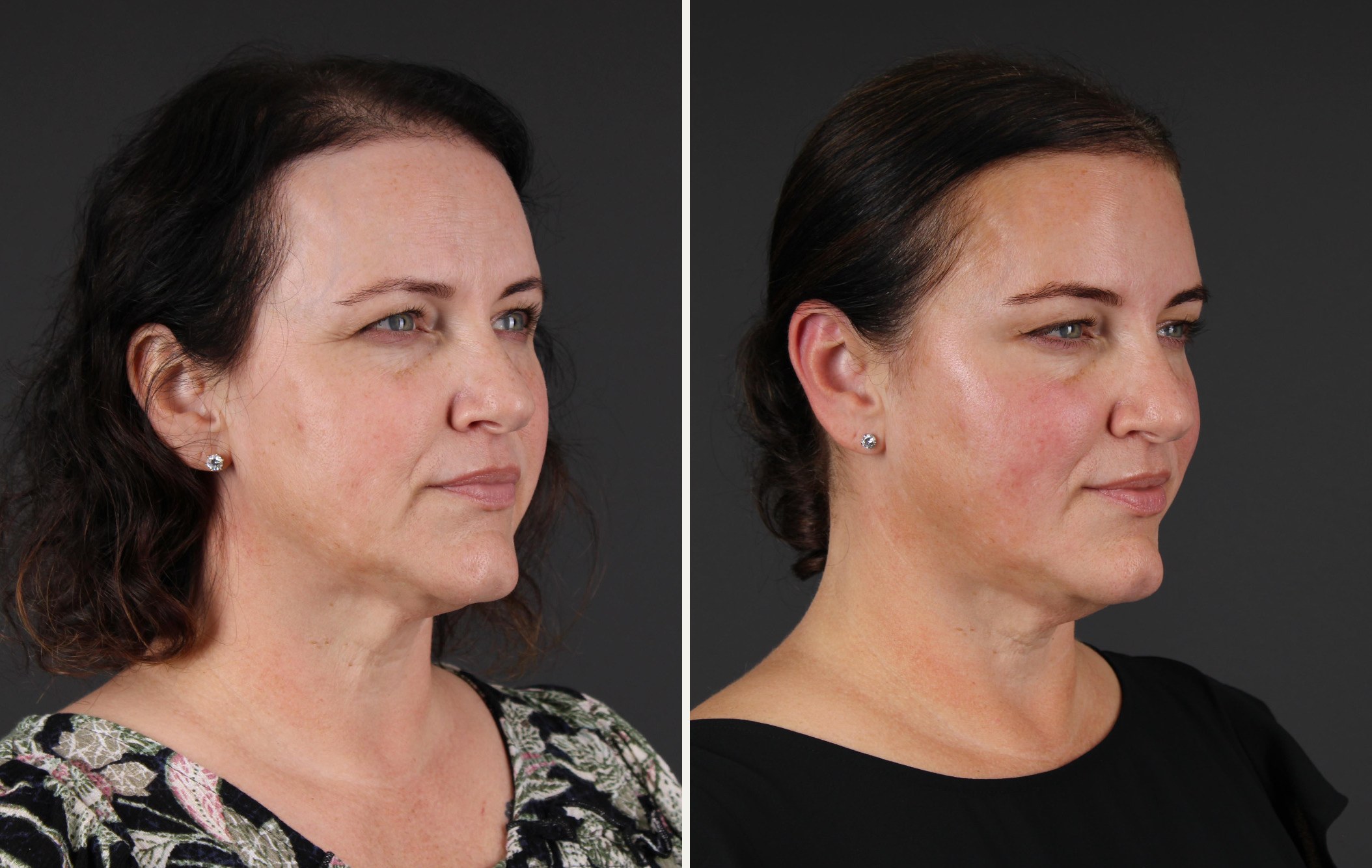 Three-quarter view of the same female patient before and after neuromodulator treatment and a skincare routine, showing fresher skin and a softer lower face