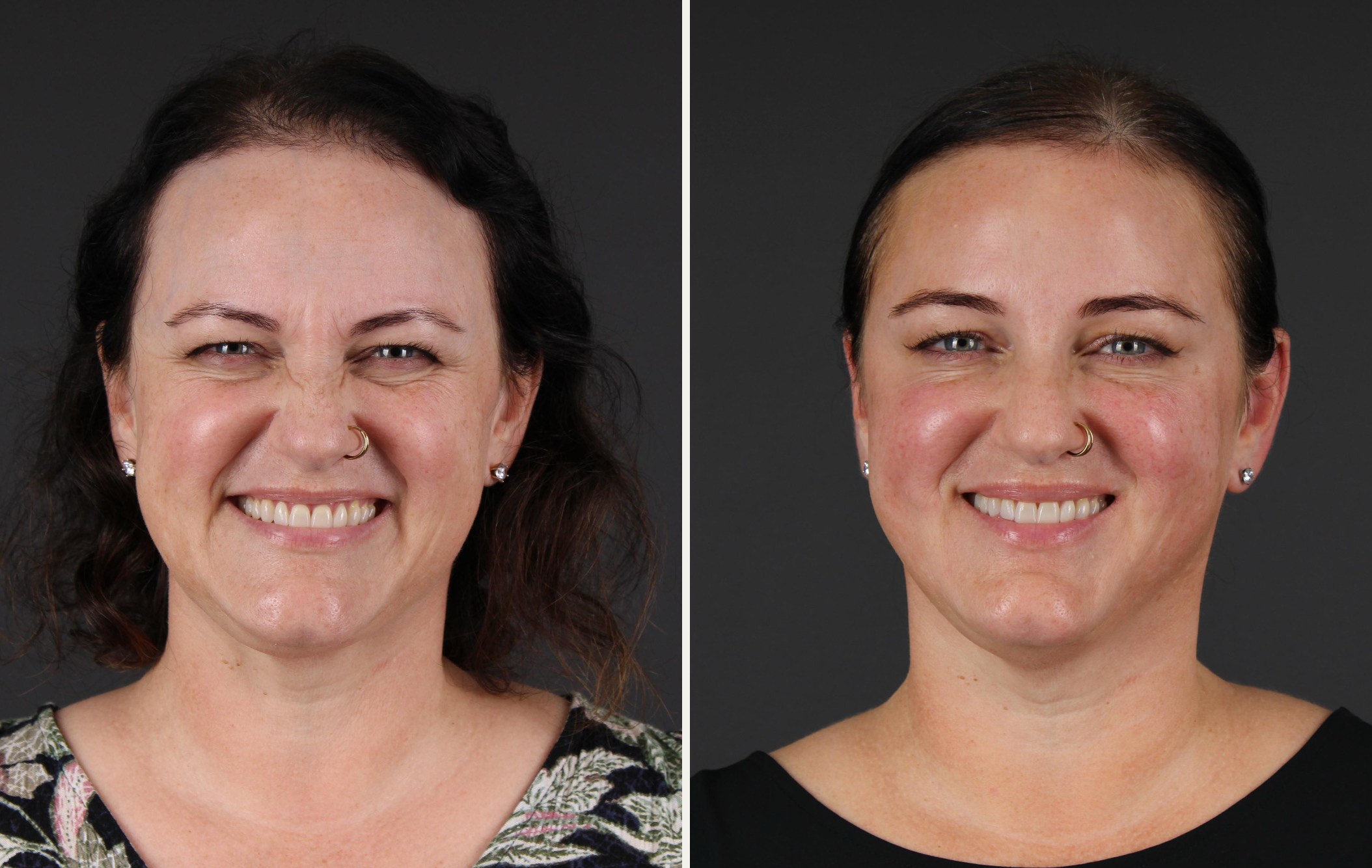 Front view of a smiling female patient before and after neuromodulator treatment and a skincare routine, showing softer lines around the eyes, nose and forehead while the smile stays natural