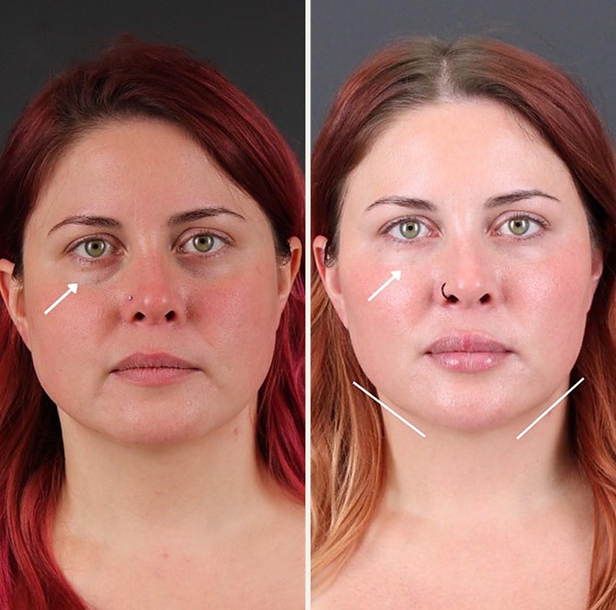 Front view of a female patient before and after facial balancing with filler, with arrows marking a softer under-eye hollow and lines marking a more defined jawline