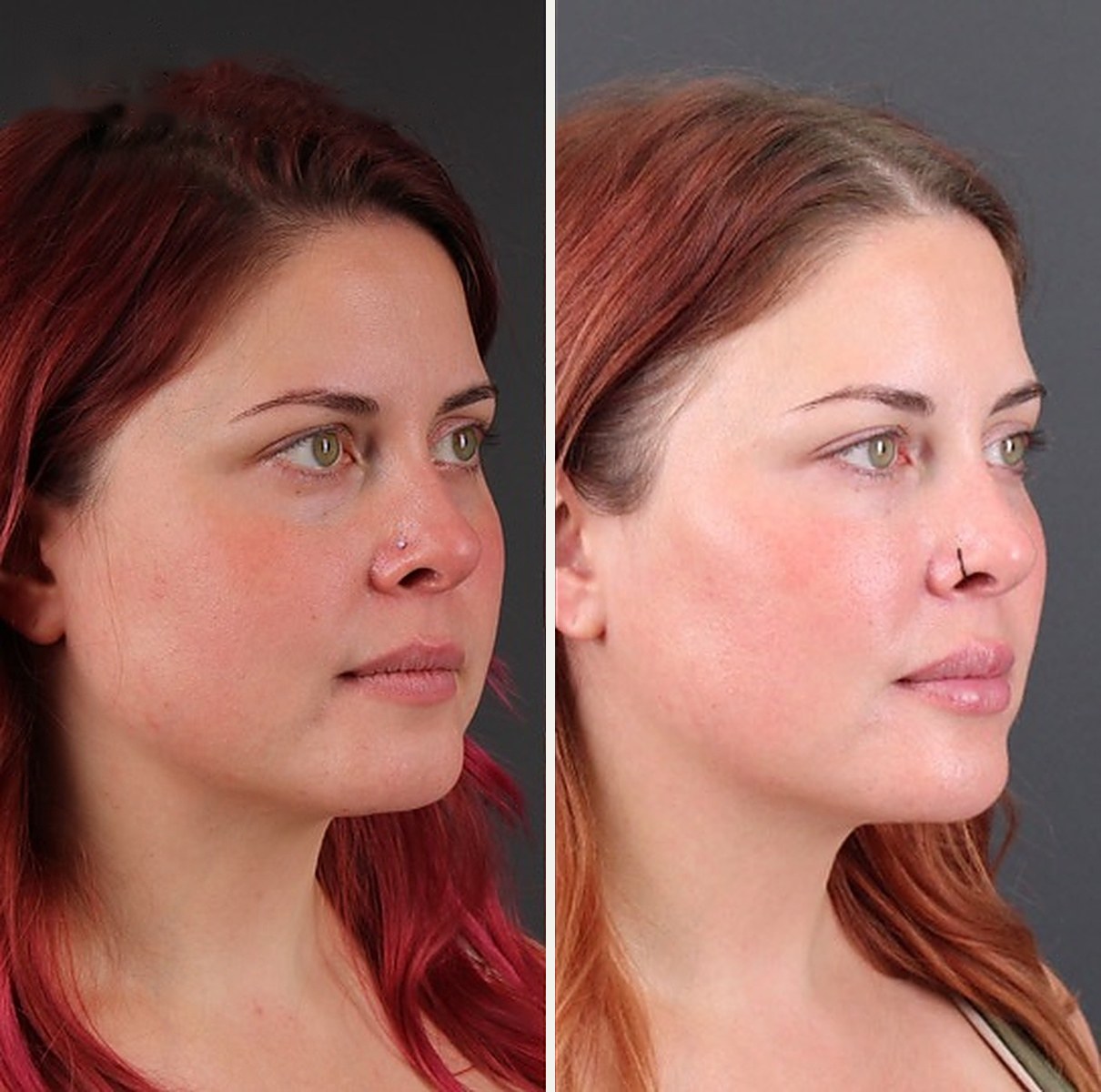 Three-quarter view of the same patient before and after facial balancing with filler, showing a smoother under-eye and a cleaner jaw and chin line