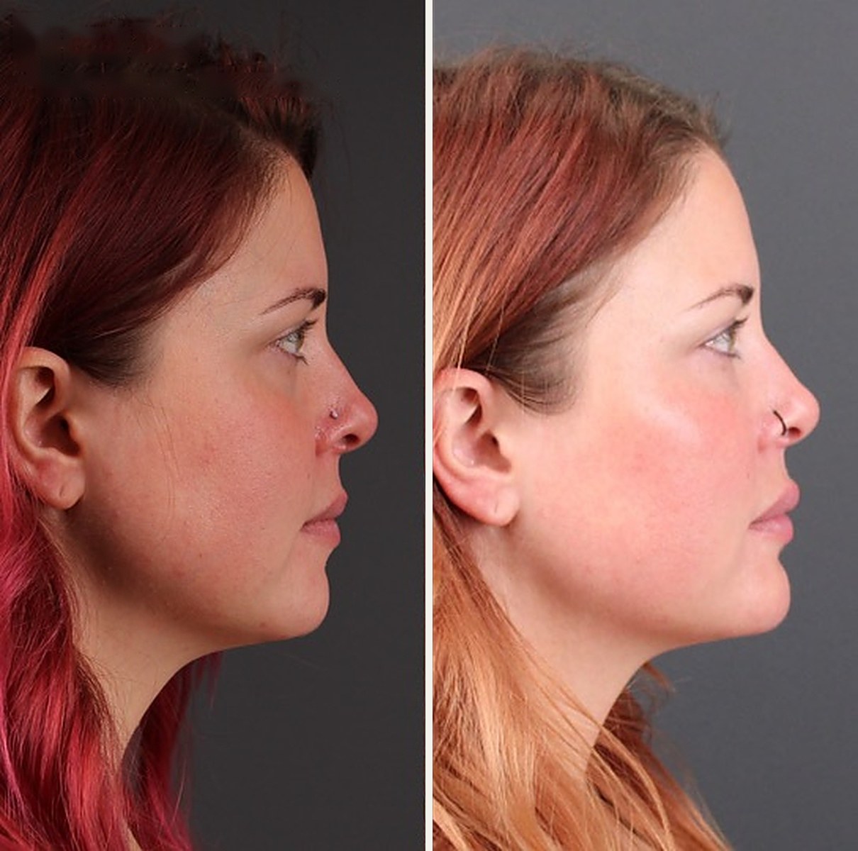Side profile of the same patient before and after facial balancing with filler, showing a more defined chin and jaw angle