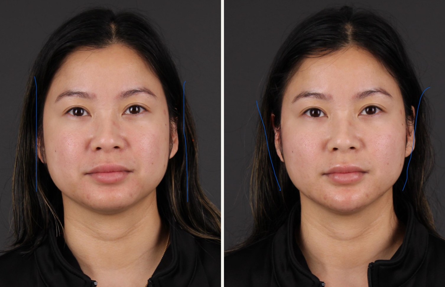 Front view of a female patient before and after facial balancing with filler, with blue lines tracing a straighter outline before and a more contoured cheek-to-jaw outline after