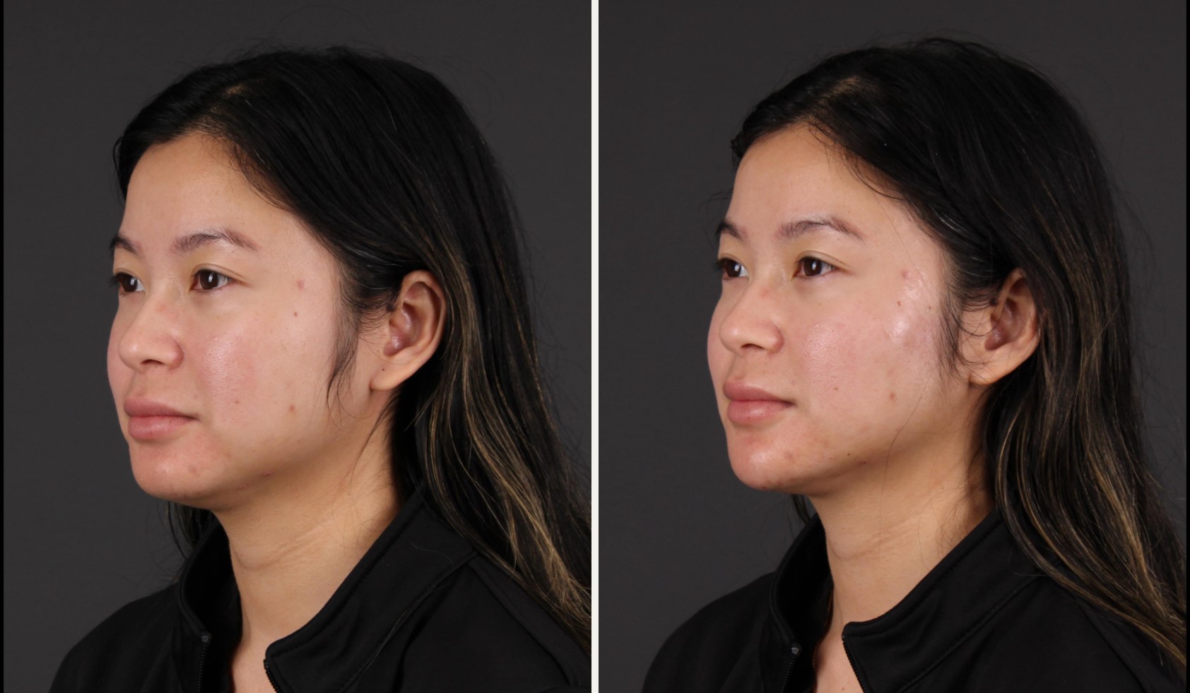 Three-quarter view of the same patient before and after facial balancing with filler, showing a more defined chin and a cleaner jawline