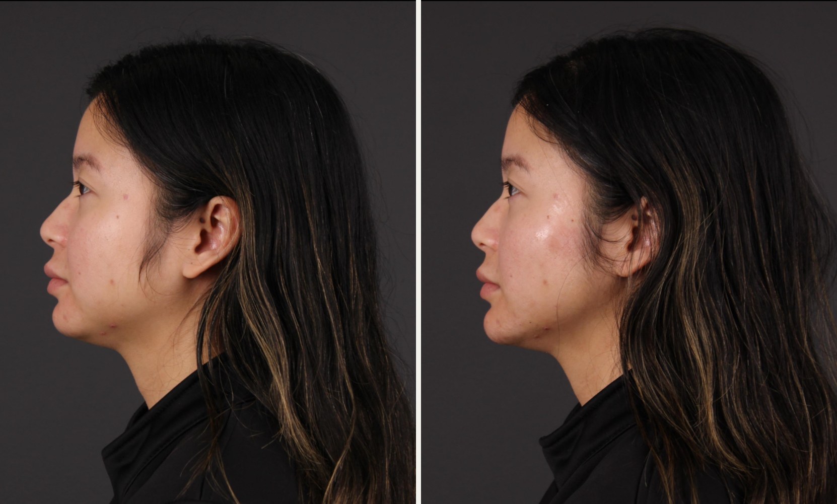 Side profile of the same patient before and after facial balancing with filler, showing improved chin projection and a sharper jaw angle