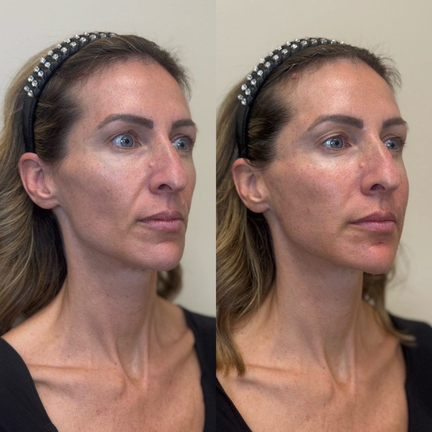 Three-quarter view of a female patient before and immediately after dermal filler and Sculptra, showing rebuilt cheek support and a fuller, smoother lower face after weight-loss related volume loss