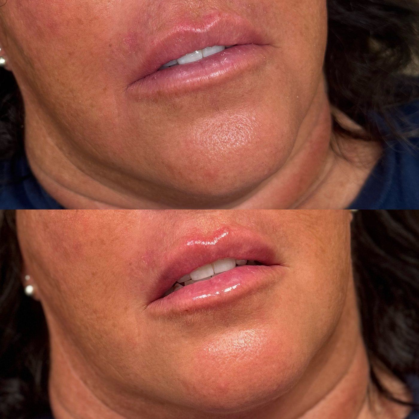 Close three-quarter view of a patient’s lips before and after 1.0 mL of Restylane, showing more hydrated, fuller lips with the same natural shape